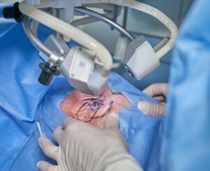 Prayer for Cataract Surgery: Seeking Healing for Vision